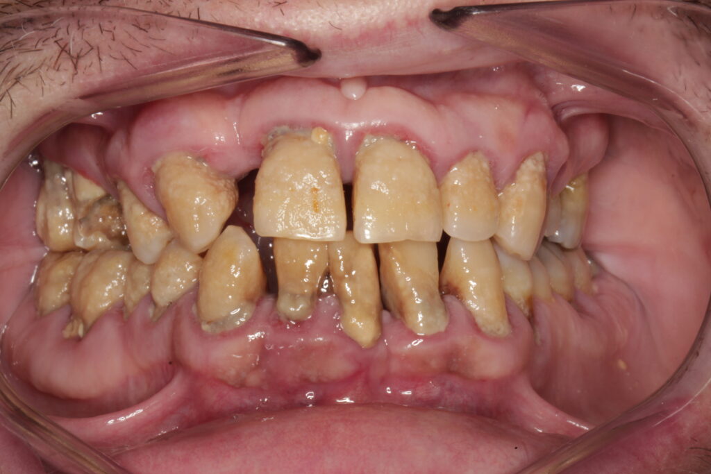 Boca con periodontitis avanzada (estadio IV) antes del tratamiento
