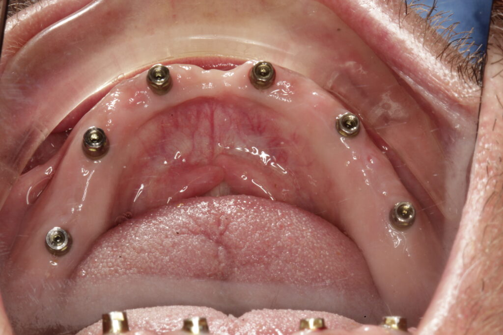 Mucosa periimplantaria sana y de biotipo grueso alrededor de los pilares tras la osteointegración