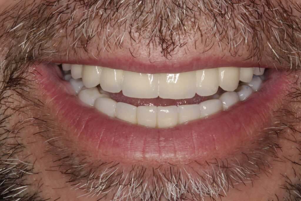 Resultado final: sonrisa rehabilitada con prótesis fija de zirconio sobre implantes