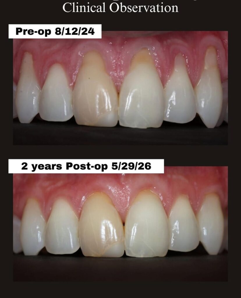 Recubrimiento de recesión gingival con técnica Pinhole: antes y a los 2 años (caso del Dr. John Chao)
