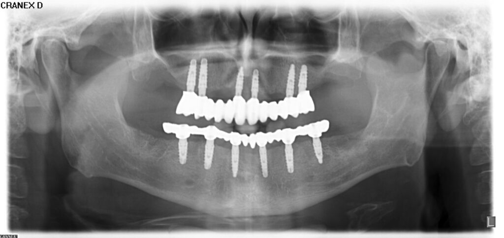 Radiografía panorámica: rehabilitación completa sobre 12 implantes